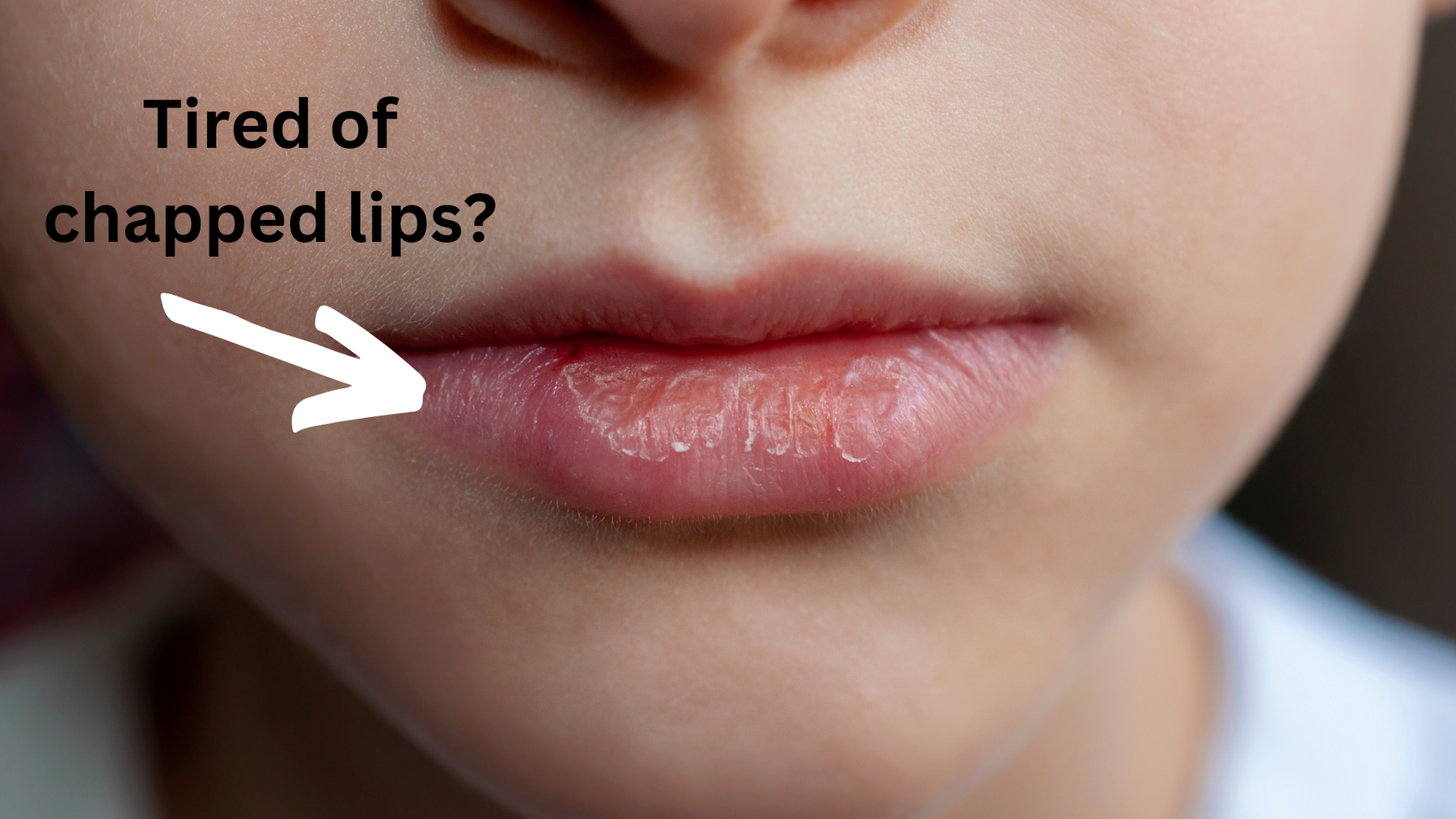Are Your Lips Chapped?