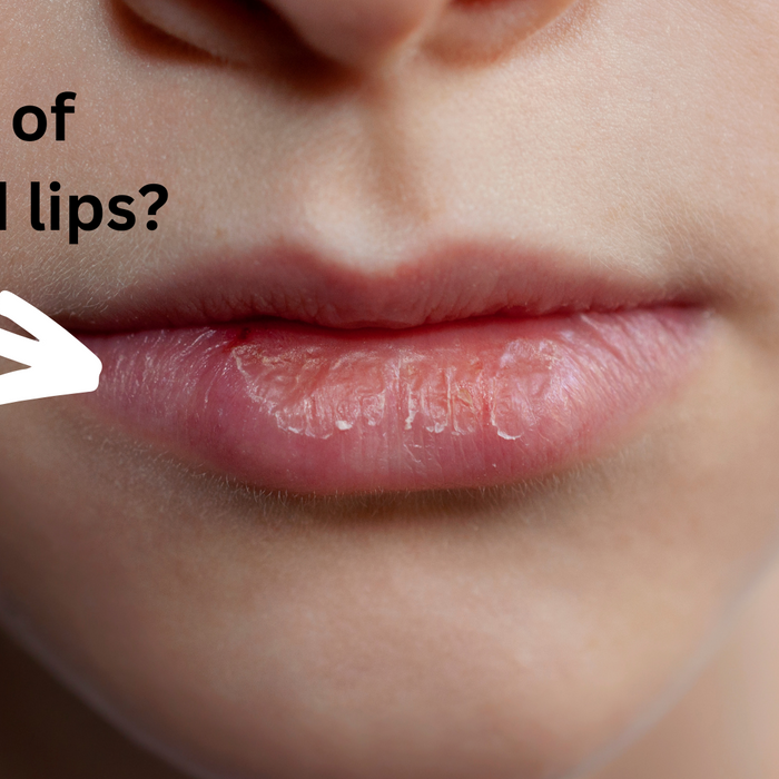 Are Your Lips Chapped?